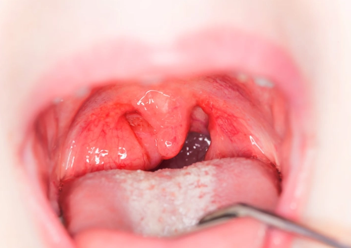 扁桃腺發炎緩解