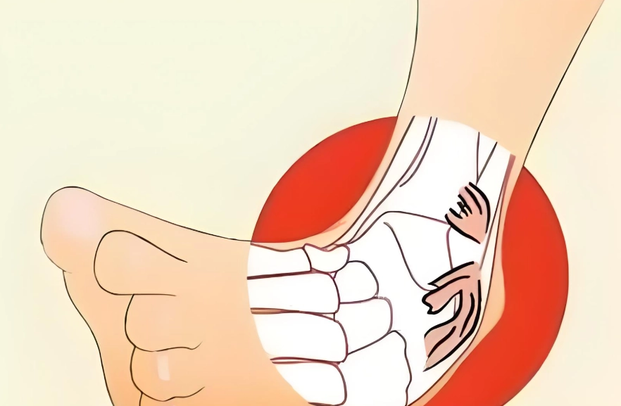 韌帶拉傷多久會好