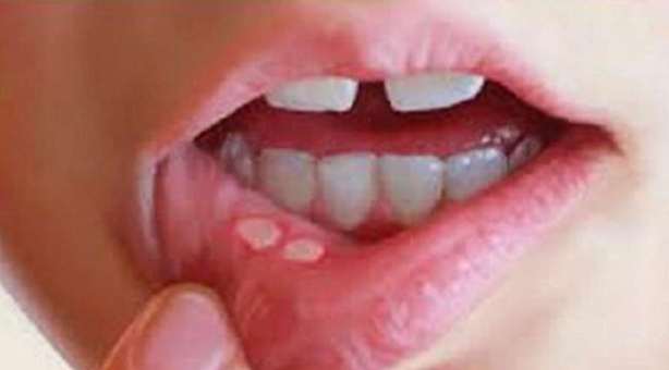 舌頭破洞如何治療