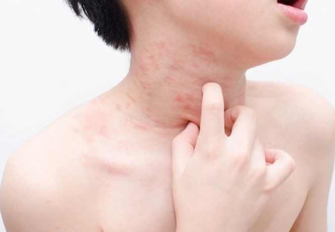 慢性蕁麻疹多久會好