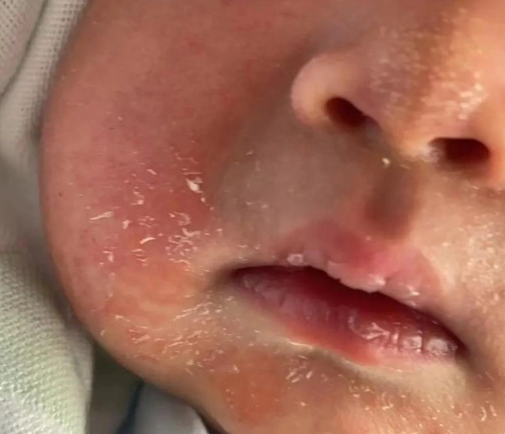 脂漏性皮膚炎嬰兒臉頰