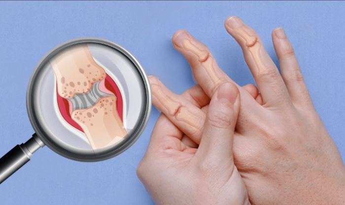 類風濕性關節炎會好嗎