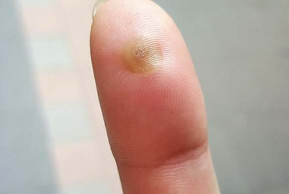 病毒疣冷凍治療