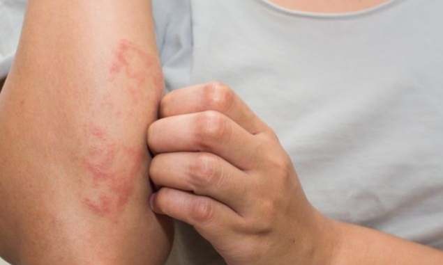 異位性皮膚炎會好嗎