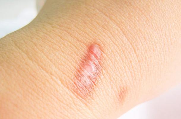 二度燙傷多久會好