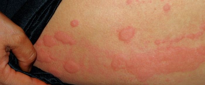 蜂窩性組織炎治療多久