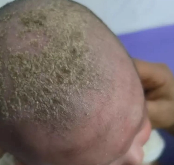 嬰兒脂漏性皮膚炎頭皮