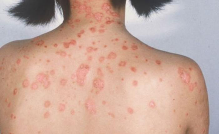 牛皮癬不能吃什麼