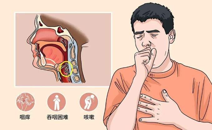 急性咽喉炎症狀