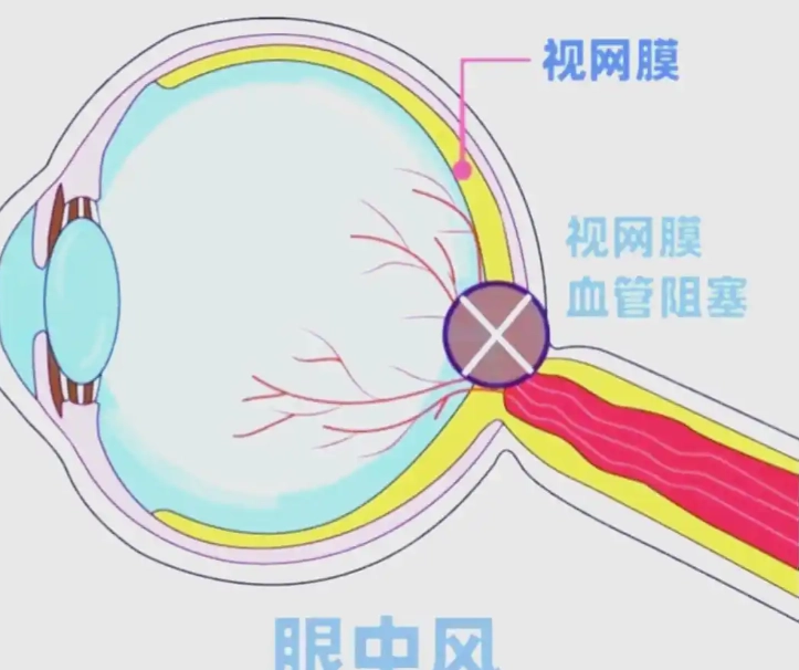 眼中風如何治療