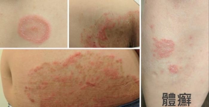 黴菌感染多久會好