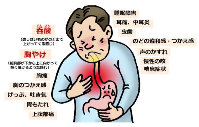 胃食道逆流喉嚨痛多久會好