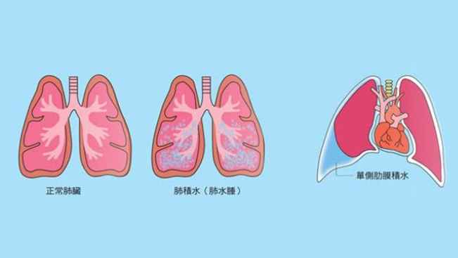 肺積水會好嗎