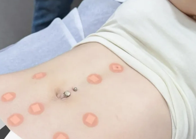 中醫埋線多久有效果