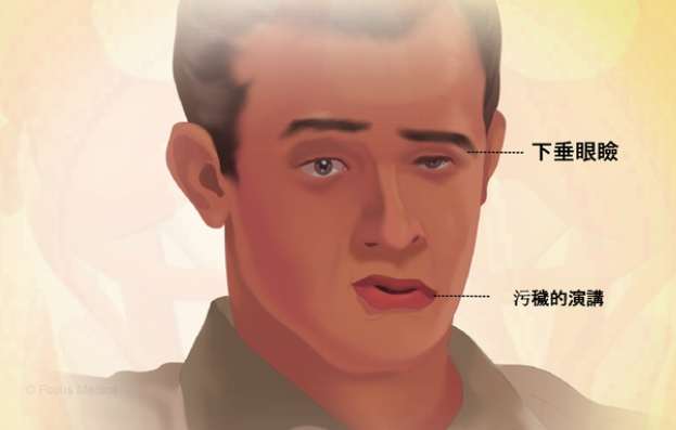 重症肌無力會好嗎