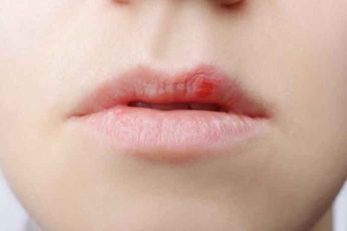 唇皰疹快速治療