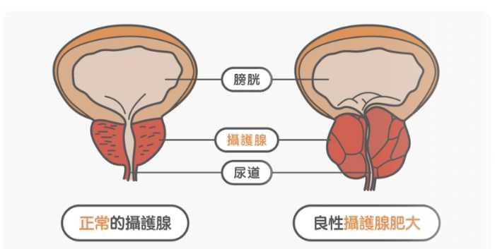攝護腺肥大吃藥會好嗎