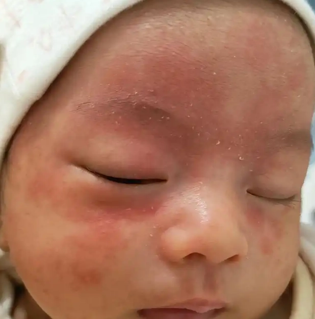 新生兒臉上紅疹怎麼辦