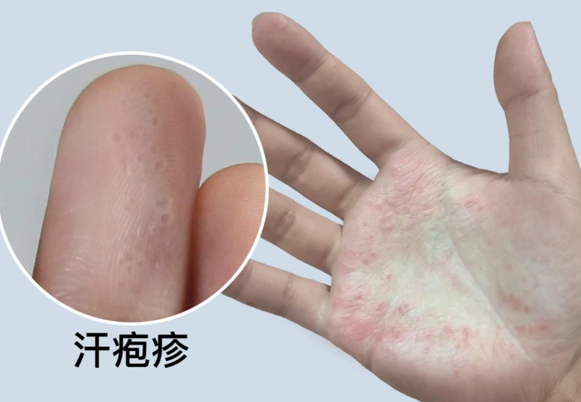 汗皰疹多久會好