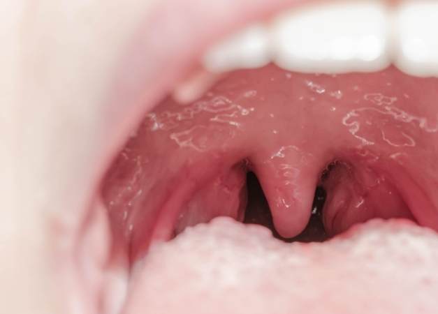 扁桃腺化膿多久會好