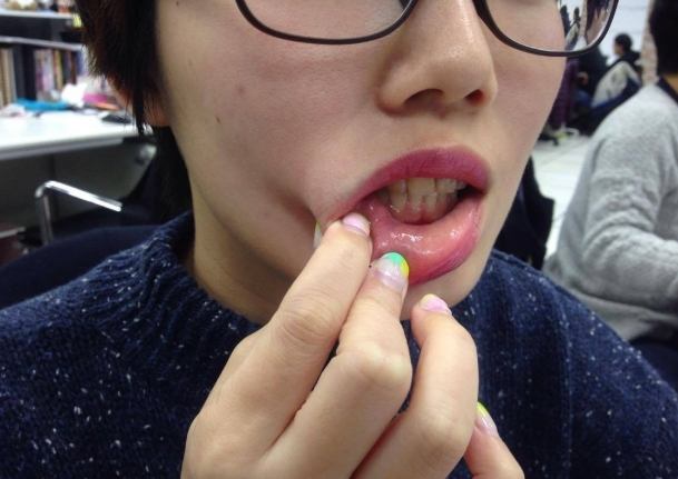 舌頭破洞多久會好