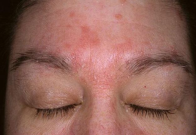 脂漏性皮膚炎多久會好