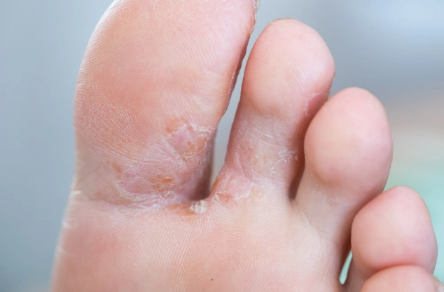 香港腳初期症狀