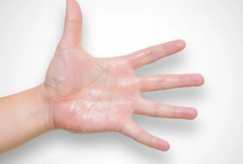 手汗治療
