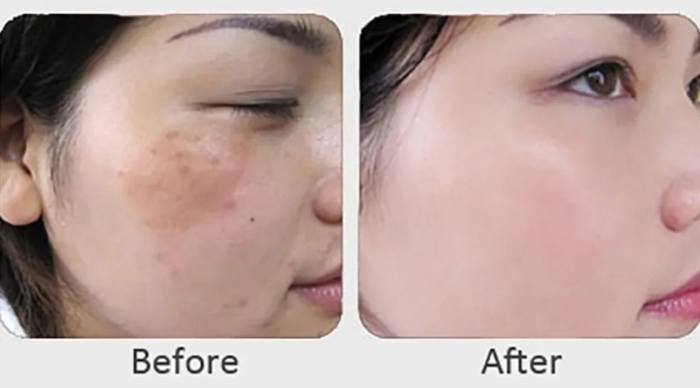 治療黃褐斑最好的方法