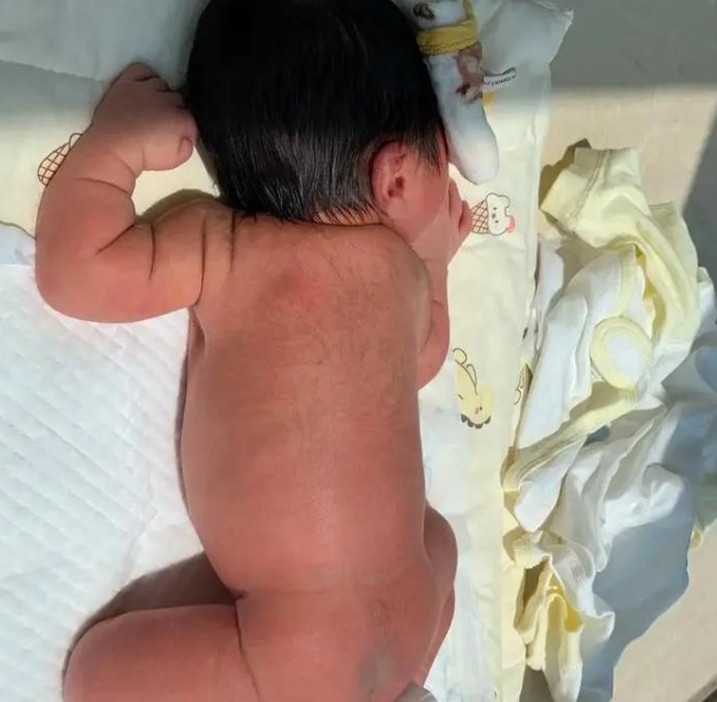 新生兒黃疸治療