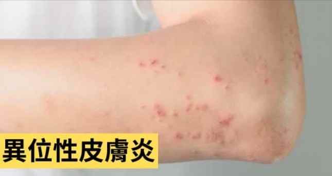 異味性皮膚炎會好嗎