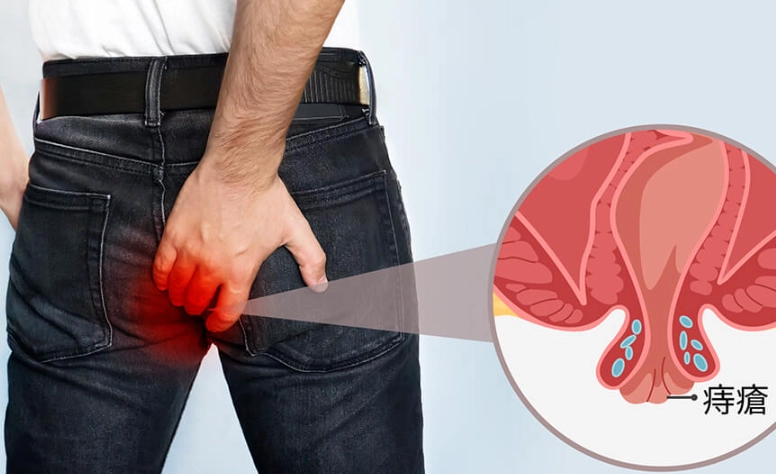 痔瘡自救