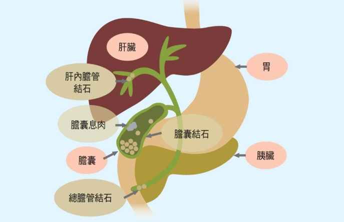 膽結石自然排出