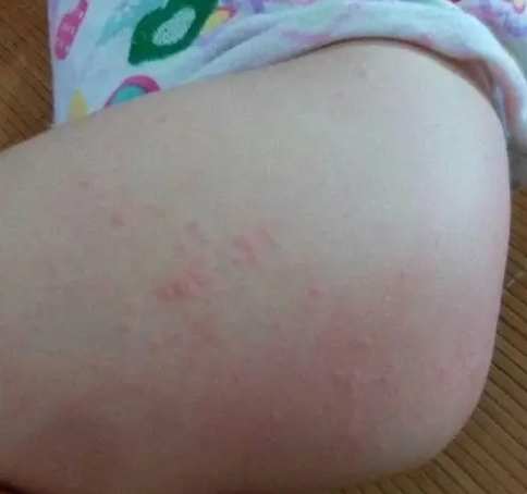 嬰兒紅屁股藥膏