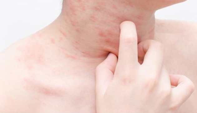 海鮮過敏多久會好