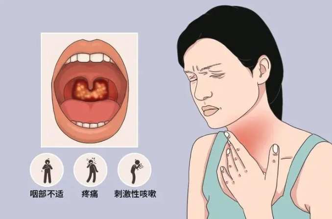 慢性咽喉炎症狀