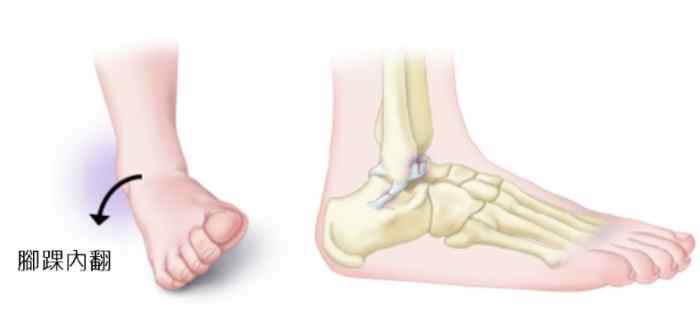 腳扭到多久會好