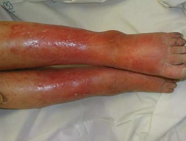 蜂窩性組織炎治療