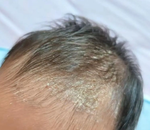 脂漏性皮膚炎嬰兒照護