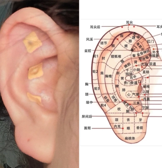 王不留行籽耳穴貼功效
