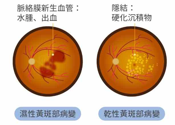 黃斑部病變會好嗎