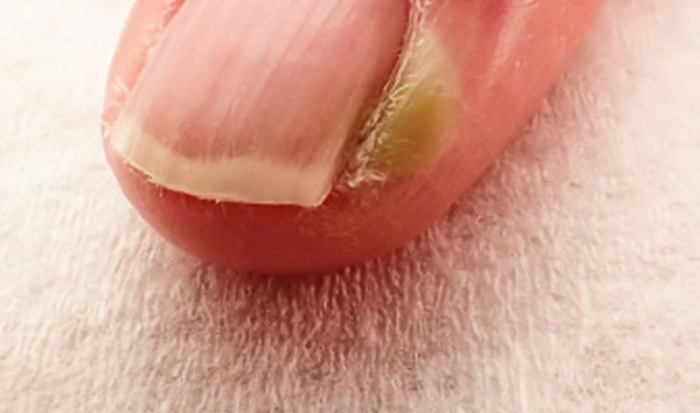 甲溝炎多久會好