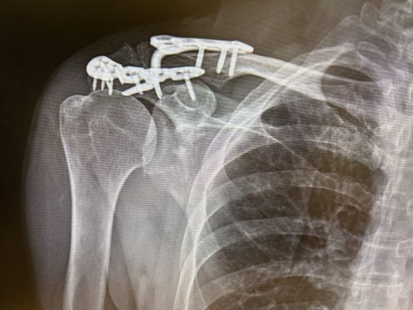 肩膀韌帶斷裂多久會好