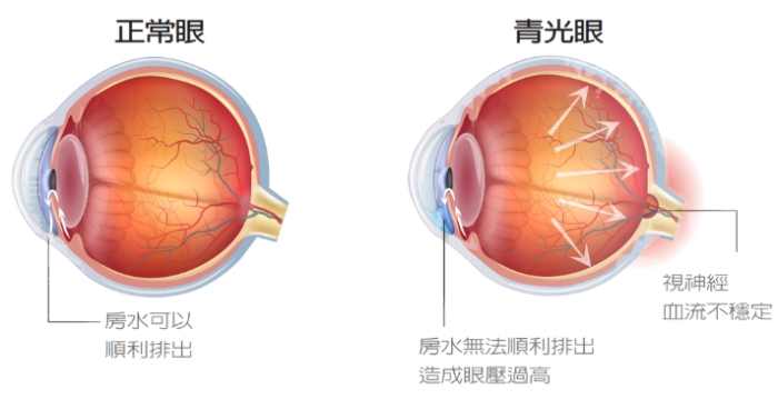 青光眼視神經修復