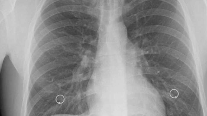 肺部纖維化會好嗎