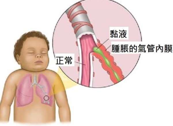 兒童支氣管炎多久會好