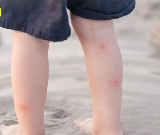 被小黑蚊咬多久會好