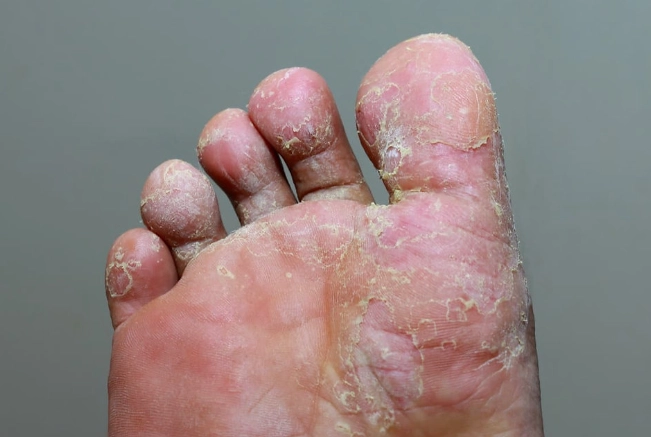 香港腳會自己好嗎