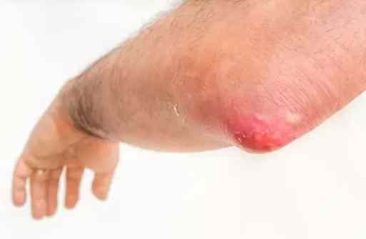 長釘子多久會好