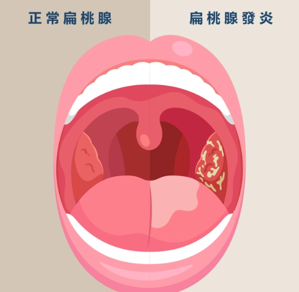 扁桃腺發炎會自己好嗎